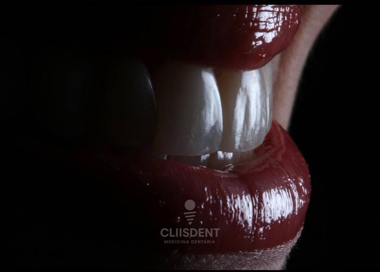 Detalhe de sorriso tratado na Cliisdent