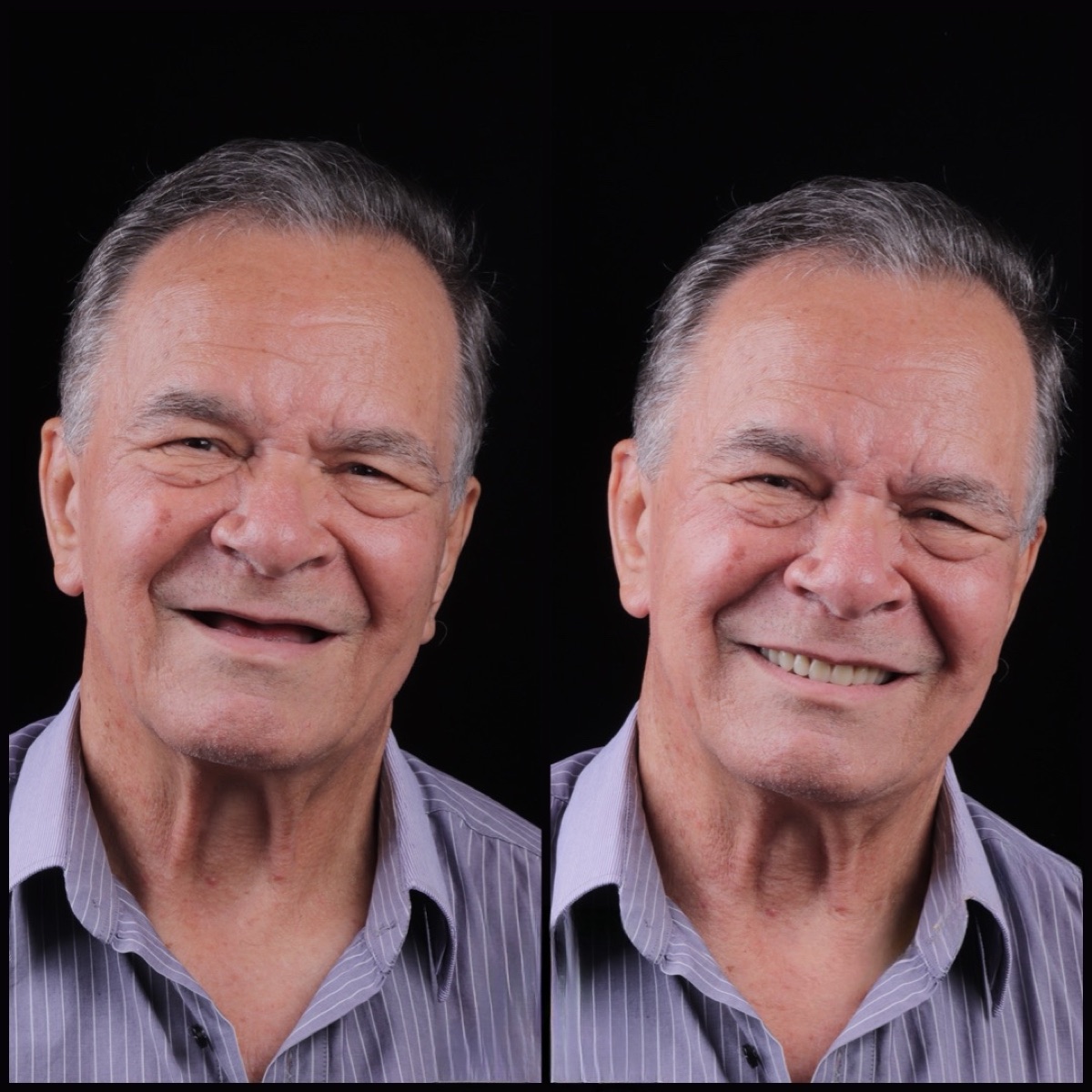 Antes e depois de tratamento dentário na Cliisdent