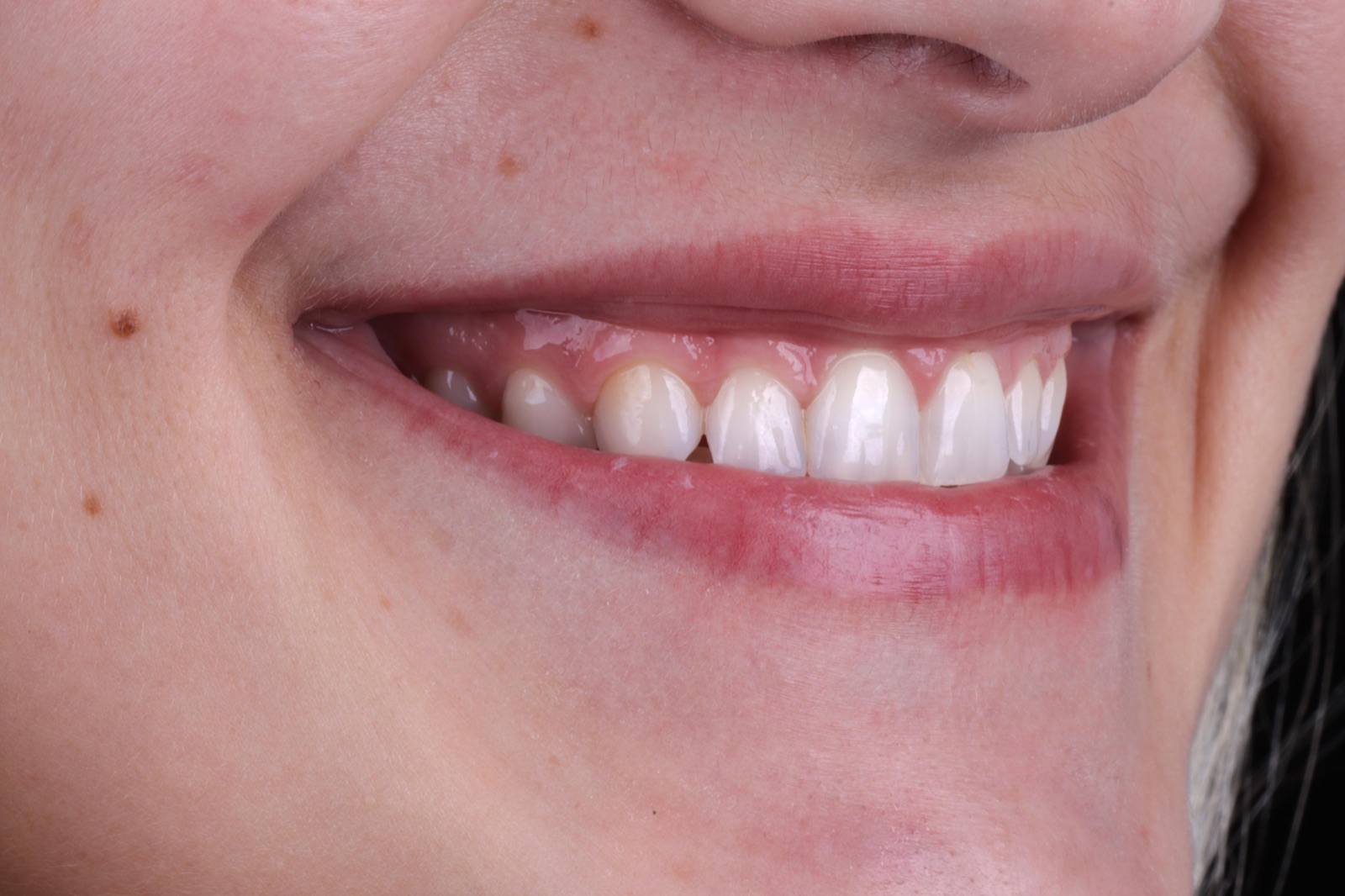 Sorriso natural de paciente da Cliisdent